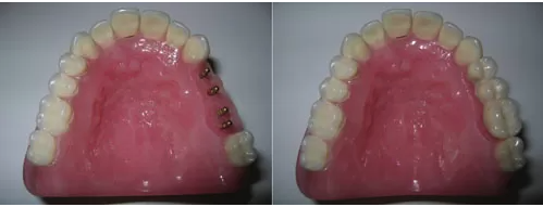 Why Mini Dental Implants? Dr. Regan Ackerman. Freedom Mini Dental Implants. Mini Dental Implants in Louisville Kentucky 40291 Why Mini Dental Implants? Dr. Regan Ackerman. Freedom Mini Dental Implants. Mini Dental Implants in Louisville Kentucky 40291