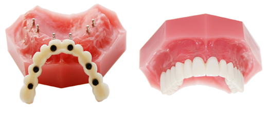 Mini Dental Implant Services in Louisville, Kentucky Dr. Regan Ackerman. Freedom Mini Dental Implants. Mini Dental Implants in Louisville Kentucky 40291