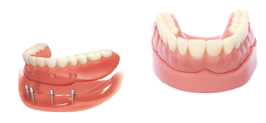 Mini Dental Implant Services in Louisville, Kentucky Dr. Regan Ackerman. Freedom Mini Dental Implants. Mini Dental Implants in Louisville Kentucky 40291