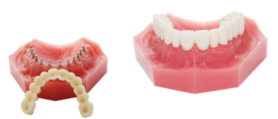 Mini Dental Implant Services in Louisville, Kentucky Dr. Regan Ackerman. Freedom Mini Dental Implants. Mini Dental Implants in Louisville Kentucky 40291
