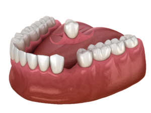 Mini Dental Implant Services in Louisville, Kentucky Dr. Regan Ackerman. Freedom Mini Dental Implants. Mini Dental Implants in Louisville Kentucky 40291