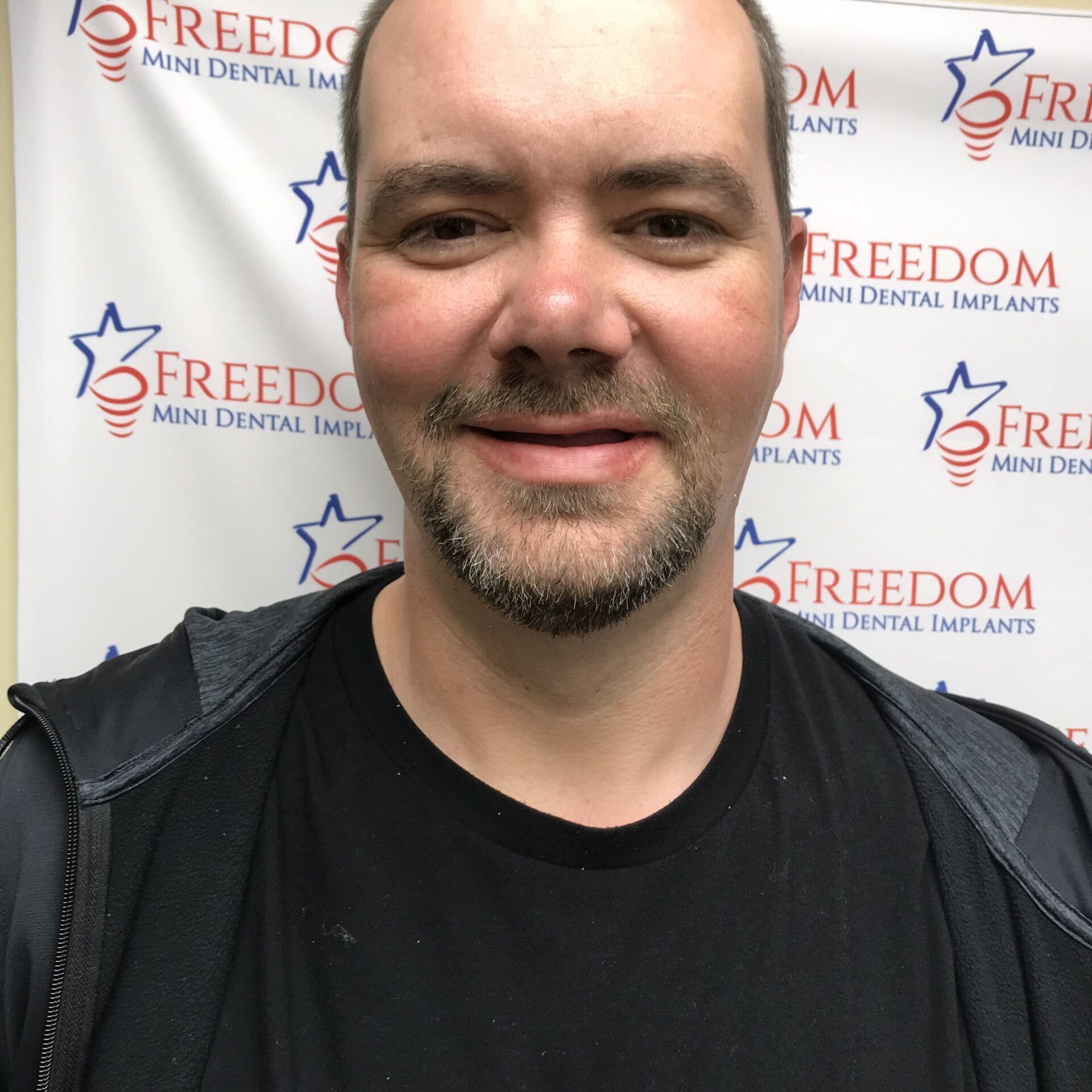 Home Dr. Regan Ackerman. Freedom Mini Dental Implants. Mini Dental Implants in Louisville Kentucky 40291