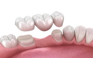 Mini Implant Detachable Bridges Louisville